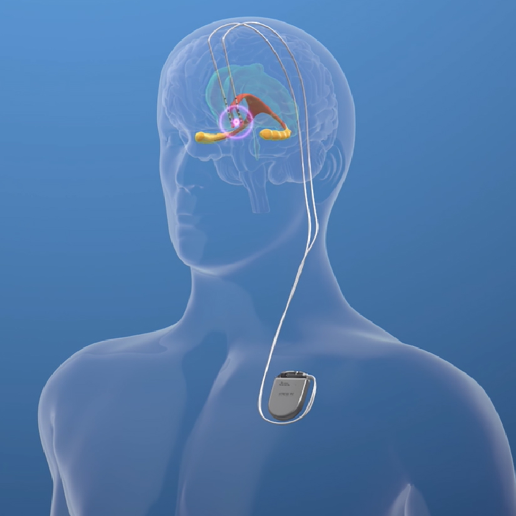 Beyin Pili Tedavisi ve Programlama - Kategori